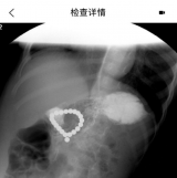 磁力球穿孔悲剧再发：请家长警惕！这类高危玩具正在威胁孩子安全